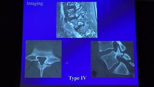 A New Classification and Treatment Algorithm for Acute and Subacute Adolescent Spondylolysis