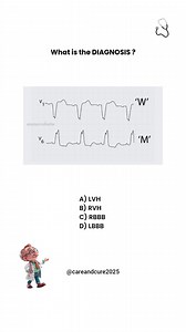 Identify this classic pattern on ECG! Comment Below ⬇️ . . . . #medical #medstudent #USMLE #mrcpuk #Cardiology | care and cure