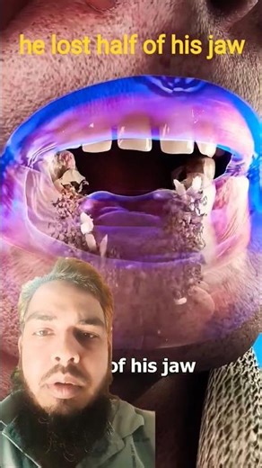 Man Rebuilds His Jaw Using His Own Leg 😮 | Medical Miracle You Won’t Believe#shorts