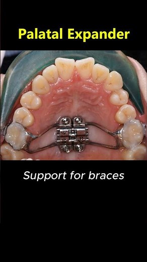 Amazing braces - Palatal expander orthodontics #dentist #braces