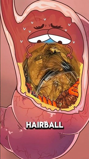 Why Eating Hair Can Form a Giant Hairball in Your Stomach ⚠️🧠
