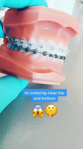 Understanding Clear Braces: Dental Model Adjustments