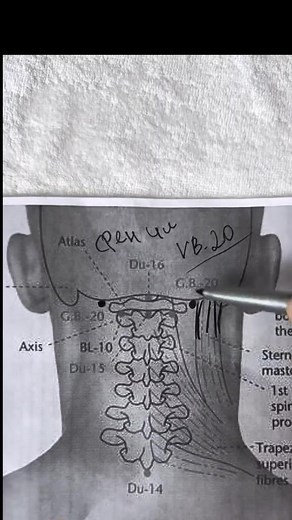 1.4M views · 13K reactions | Yurii Zozulia-Physiotherapy on Reels | Facebook