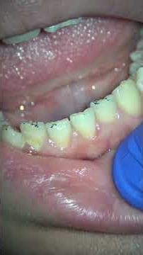 The Story of a Central Incisor - Checking the bite