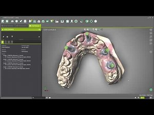 DWOS - Create Custom Abutments