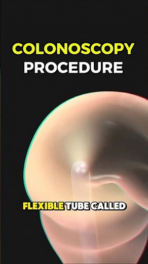 Colonoscopy Procedure Explained | 3D Medical Animation in 60 Seconds#facts #3danimation #colonoscopy