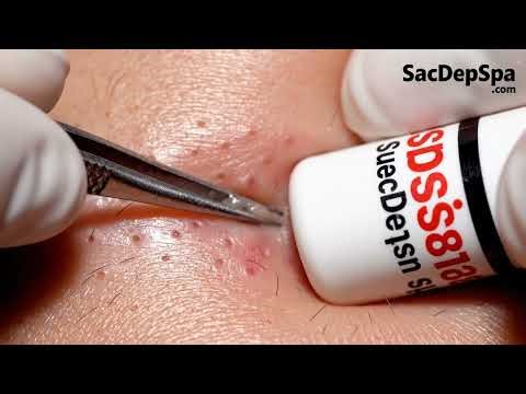 Blackhead & Whitehead Extraction: Satisfyingly Gross Pus Removal! 🤢🔥