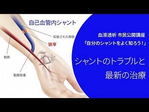 血液透析 シャントのトラブルと最新の治療【市民公開講座】