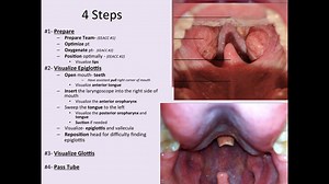 EEACC #4- Direct Laryngoscopy