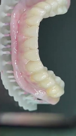 Prótesis realizada en impresión 3d
