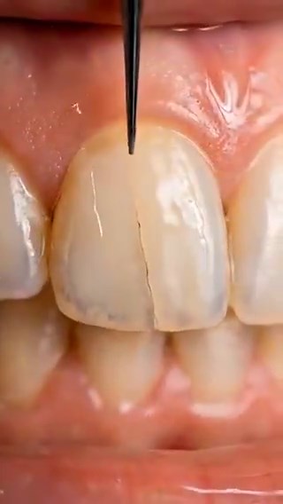 The brocken teeth is getting to repair