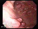 Gastric Polyposis - Endoscopy (3 of 11) • Video • MEDtube.net