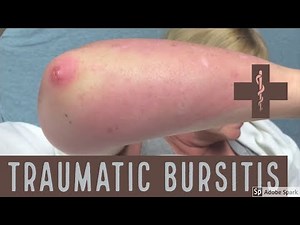 traumatic bursitis