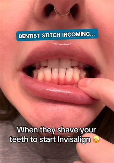 For patients with crowded teeth, we sometimes perform IPR (interproximal reduction) before Invisalign. This simply means gently creating a tiny amount of space between certain teeth so they have room to move, rotate, and align properly. Without that space, the teeth can’t shift into their ideal position. The good news? Those gaps are part of the process. As your Invisalign trays continue moving your teeth, the spaces gradually close. Temporary space → properly aligned teeth → a healthier, straig