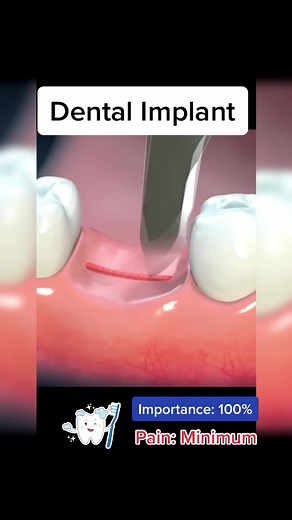 Understanding the 2-Step Dental Implant Procedure