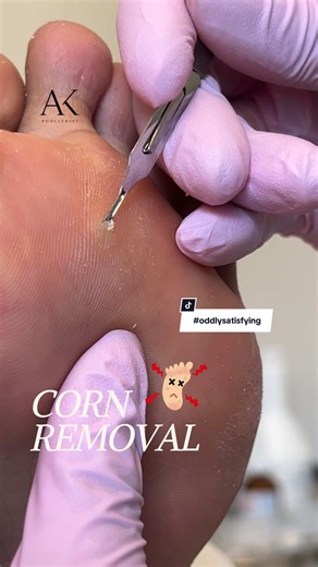 Satisfying Corn Removal: Tips for Healthy Feet