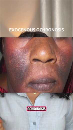 Exogenous Ochronosis: A Preventable Problem When hyperpigmentation treatments are misused, the skin can respond with something far worse. Exogenous ochronosis is a chronic, often irreversible darkening linked to prolonged hydroquinone use, especially without medical guidance. This is why supervision, formulation, and duration matter. Healthy skin is built with strategy, not shortcuts