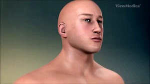 中英文字幕：颈前路椎间盘切除融合术（ACDF）