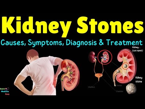 kidney stones (Nephrolithiasis) - Major Types & Their Causes, Treatment, Prevention