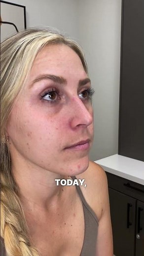 Tear Trough Filler | The Solution To Dark Circles and Under Eye Hollows