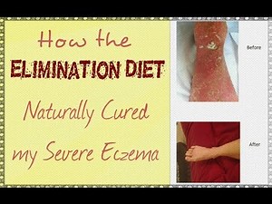 How the Elimination Diet Naturally Cured My Severe Eczema