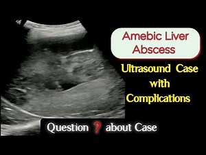 Amebic Liver Abscess - Ultrasound Rare Case showing many Complications
