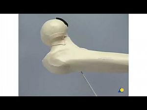 AO 7.3mm Cannulated Screw: Femoral Neck Fracture