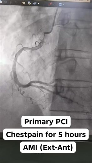 Primary PCI: Save Lives Through Fast Heart Attack Response