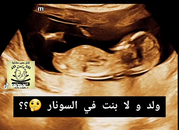 ‏ولد و لا بنت في السونار 🤔؟؟