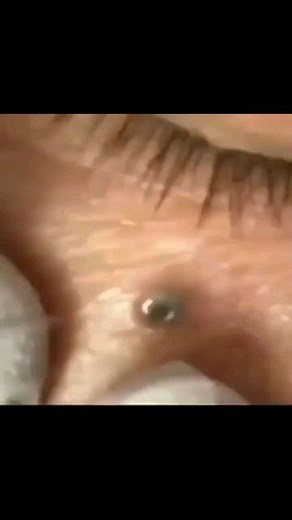 Pimple Popping 2021 | Follow • @bigpimplevideos and get awesome skin routine tutorial 😍 . . . . . . . . . . . #pimple #acne #skincare #blackheads #pimples... | Instagram