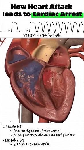 How Heart Attack leads to Cardiac Arrest (Simple Explanation) #cardiacarrest #cardiology #ecg