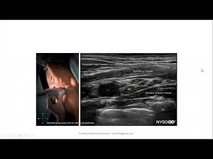lecture presentation : ultrasound guided costoclavicular block