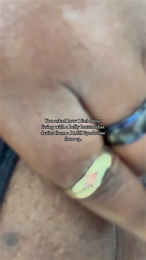 Destineé Spruell on Instagram: "PASH syndrome in the belly button is something no one prepares you for, and honestly, no one really talks about. One day it looks like it’s healing, the next it’s reopened, draining, inflamed, and demanding attention all over again. It’s not just a physical wound — it becomes mental, emotional, and exhausting. Every outfit has to be chosen carefully. Every movement is calculated. I’m constantly aware of leakage, pain, smell, and the fear of it soaking through my c