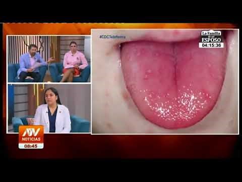 Diferencias entre la Viruela del Mono y la enfermedad Manos, Pies y Boca