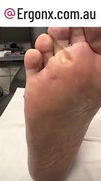 Podiatrist Removes Hard Forefoot Corn Live #FootCare #Podiatry