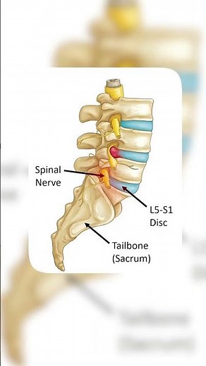 Advanced Treatment for L5–S1 Nerve Compression | Dr. Satyam Jaiswal (Chiropractor)