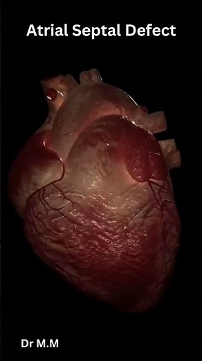 Atrial Septal Defect Murmur: The Classic Fixed Split S2 Explained!