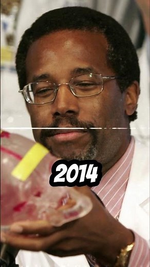 What Happened to Siamese Twins Ben Carson Separated Benjamin and Patrick Binder #shorts #history