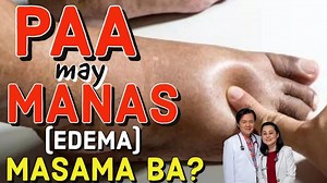 PAA May Manas (EDEMA) MASAMA BA? Payo ni Doc Willie Ong May mga seryosong dahilan ng pagmamanas ng paa: 1. Sakit sa puso ang isang dahilan o Heart Failure. Ang gamutan ay pampaihi at bawasan ang tubig na iniinom. 2. Sakit sa Kidney. Kapag hindi ginamot agad ay mauuwi sa kidney failure at dialysis. 3. Sakit sa Atay o liver cirrhosis. Nagmula ito sa pagkasira ng atay dahil sa alak. Alamin sa Video: | Doc Liza Ramoso-Ong