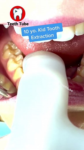 10 yo. Tooth Extraction #dentist #dental #kidsdentist