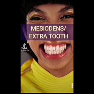 4K views · 60 reactions | In this video, i will explain how i treated a case of Supernumerary or extra tooth. The extra tooth was removed and the gap or space was corrected using metal braces. Mimiyuuuh's teeth Extra tooth Supernumerary tooth Sobrang ngipin Extra tooth explained Credits to MIMIYUUUH @mimiyuuuh Picture was used for educational purposes. | Doc She - Your Smile Doctor | Facebook