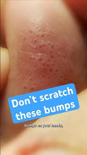 Don't Scratch These Bumps
