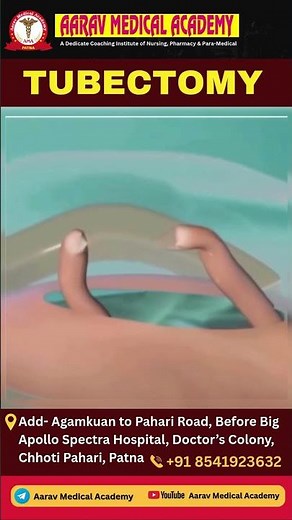 Tubectomy – A Permanent Method of Female Contraception | महिला नसबंदी | #tubectomy #shorts