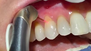 9.5K views · 308 reactions | Class 5 with Laser. Credit Joseph Sarkissian DDS #Dentistry #LearningTips | Bites & Braces Dental | Facebook