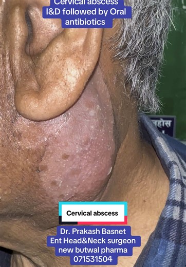 Cervical Abscess Treatment Insights