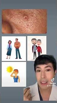 How to treat Sebaceous Gland Hyperplasia