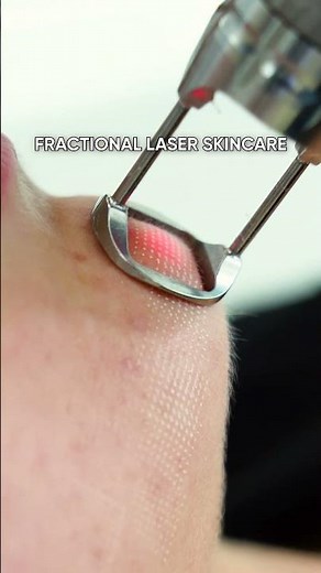 Transform Your Skin with Fractional Laser Therapy