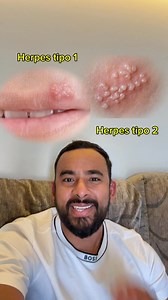 Diferencias claves entre Hérpes tipo 1 y Hérpes tipo 2 #viralreelsシ | Dr. Esteban Contreras