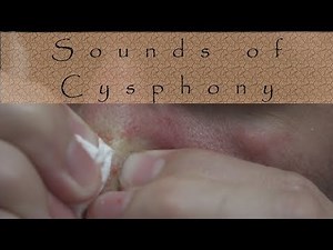 Sounds Of The Cysphony | Life With Cystic Acne Documentary #49