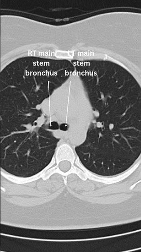 Discover the intricate details of thorax CT anatomy in this comprehensive YouTube video.